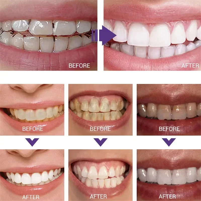 Teeth Cleansing Whitening Toot - Teeth Whitening In Korea ulasan dan harga