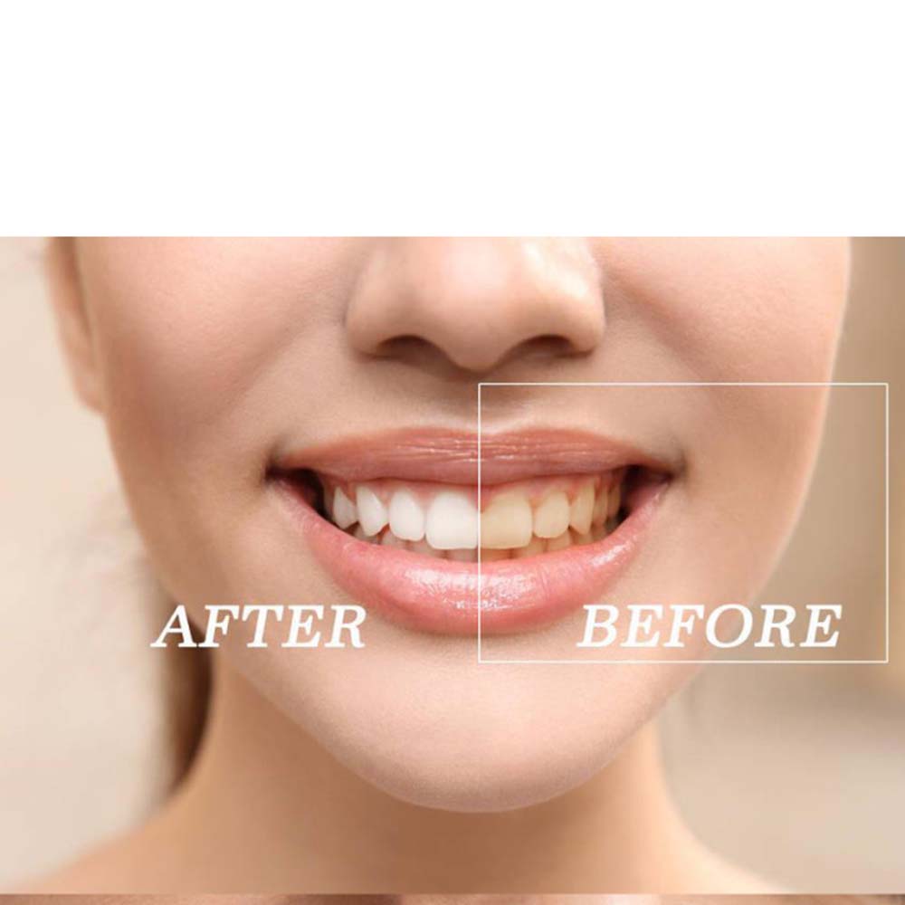 Top Quality Peroxide Teeth Whi - Teeth Whitening Kit With Light ulasan dan harga