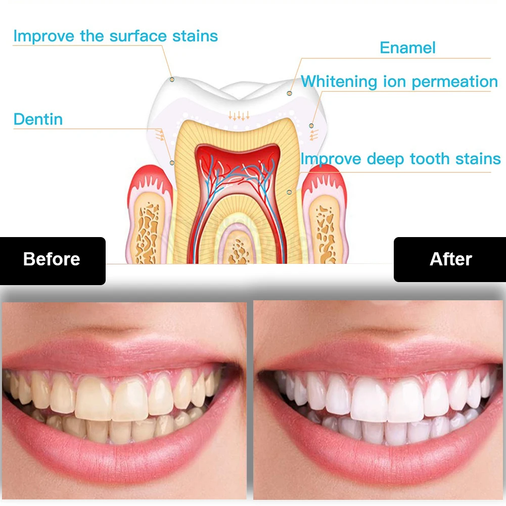 Dental Teeth Whitening Kit Min - Teeth Whitening Kit With Light ulasan dan harga